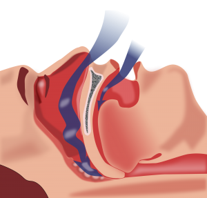  patients with OSA